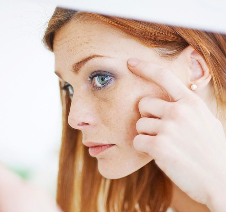 Cievne prejavy na tvári sú neestetické